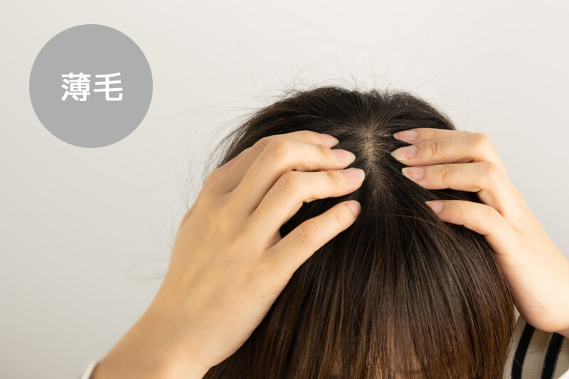栄養不足によるヘアトラブル「薄毛」